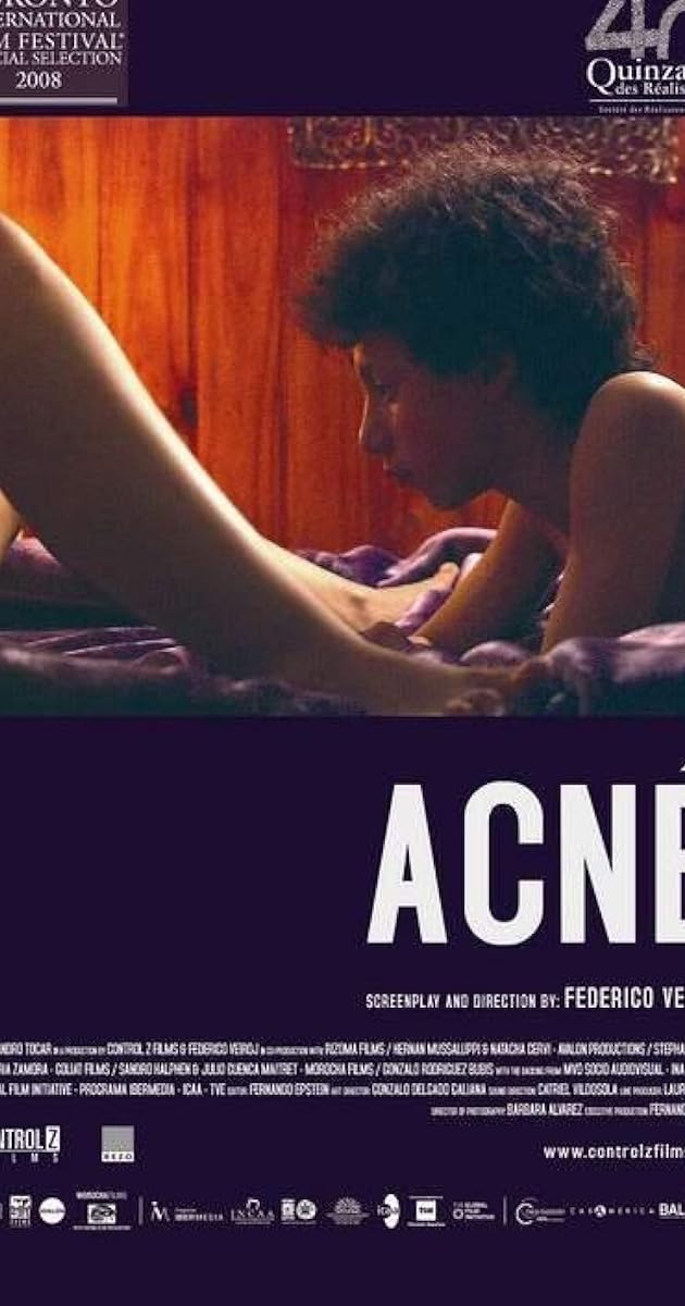Acné